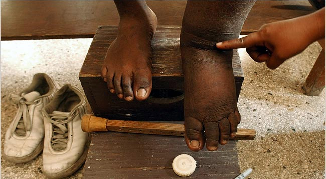 हात्तीपाइले रोगको औषधी अनिवार्य खान आग्रह